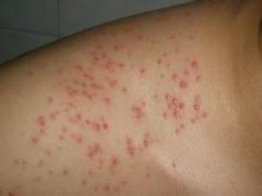 毛囊炎怎么护理方法的