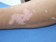 白癜风注意什么护理