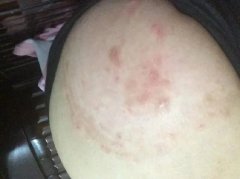 皮炎引起原因有什么