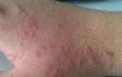 生活中引起皮炎怎么样的