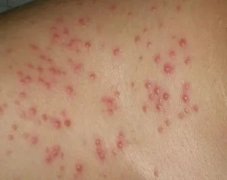 引起毛囊炎原因怎么样的