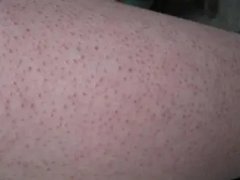 如何治疗毛囊炎的方法