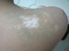 患有白癜风怎么治好