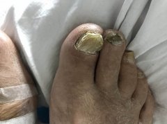 灰指甲症状特点有什么