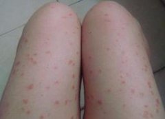牛皮癣应该怎么缓解的