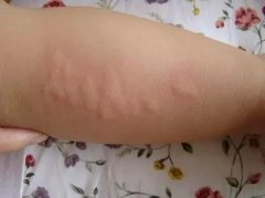 造成荨麻疹原因有什么