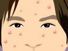 青春痘怎么治疗的方法