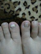 如何预防灰指复发方法