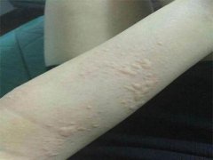 荨麻疹患者饮食注意事项