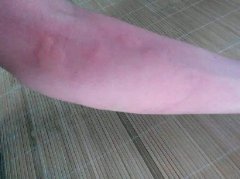 荨麻疹的类型有什么