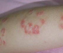 引起男性寻常型银屑病怎么回事