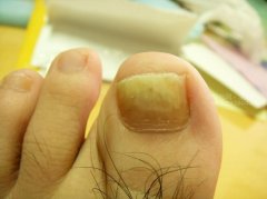 怎么预防灰指甲方法
