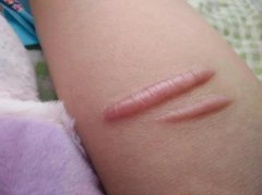 预防疤痕要注意事项