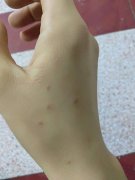 疥疮的护理措施怎样