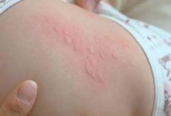 得了荨麻疹应怎么做